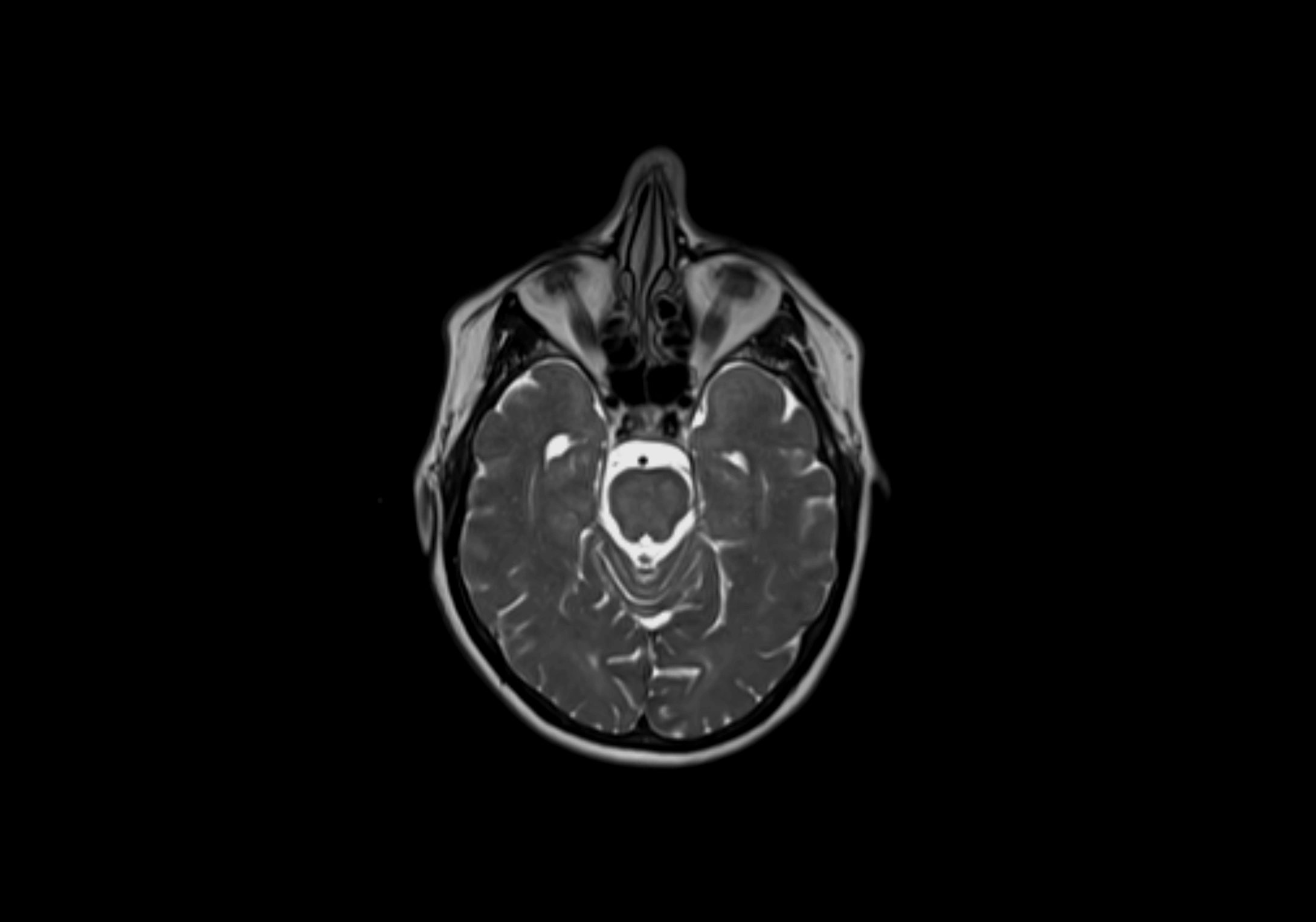 Neck axial  lymph node cross sectional MRI anatomy 3T MRI  image-img-00001-00007.webp